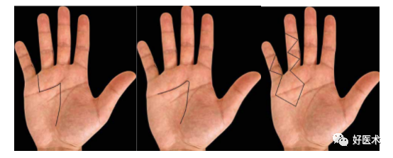 做好掌腱膜挛缩的治疗，手把手教程荐读！