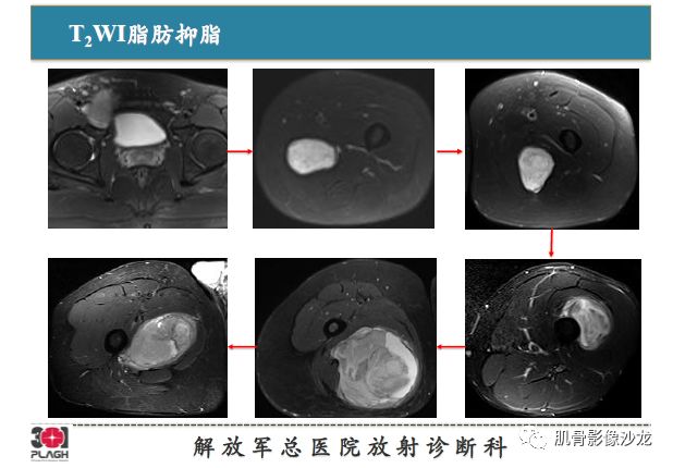 软组织肿瘤MRI诊断，这份分析思路请收下！