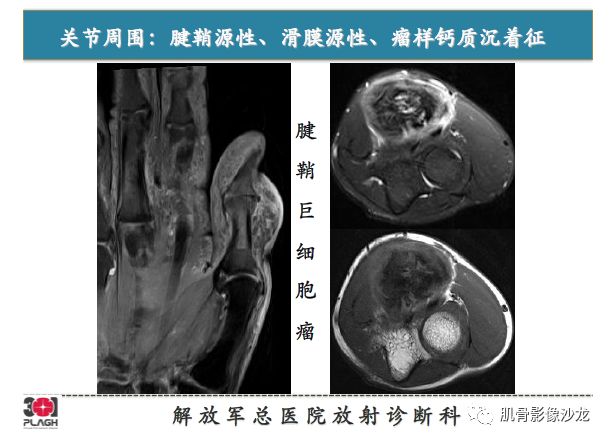 软组织肿瘤MRI诊断，这份分析思路请收下！