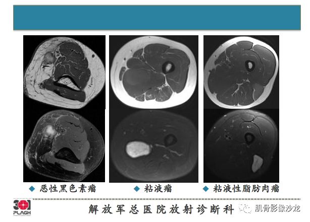 软组织肿瘤MRI诊断，这份分析思路请收下！