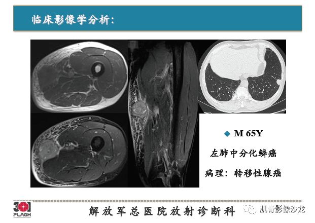 软组织肿瘤MRI诊断，这份分析思路请收下！