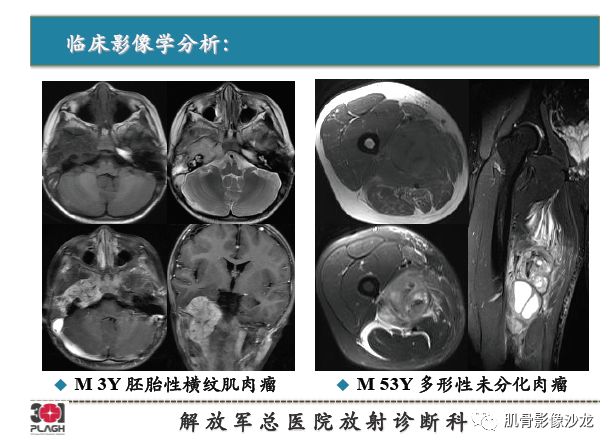 软组织肿瘤MRI诊断，这份分析思路请收下！