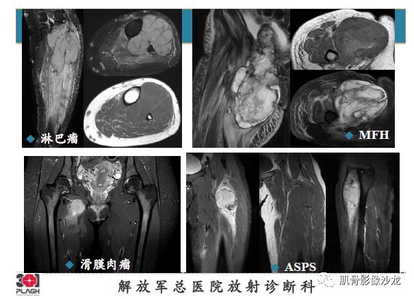 软组织肿瘤MRI诊断，这份分析思路请收下！