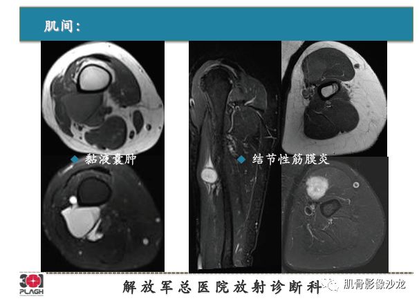 软组织肿瘤MRI诊断，这份分析思路请收下！