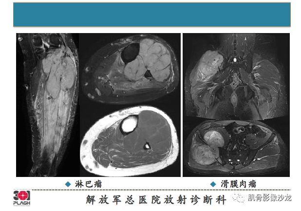 软组织肿瘤MRI诊断，这份分析思路请收下！