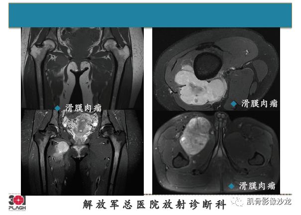 软组织肿瘤MRI诊断，这份分析思路请收下！