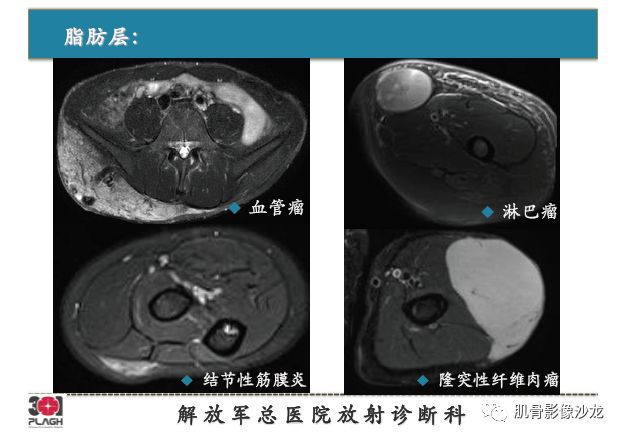 软组织肿瘤MRI诊断，这份分析思路请收下！