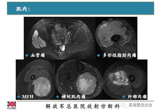 软组织肿瘤MRI诊断，这份分析思路请收下！