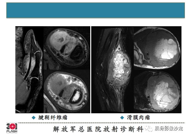 软组织肿瘤MRI诊断，这份分析思路请收下！