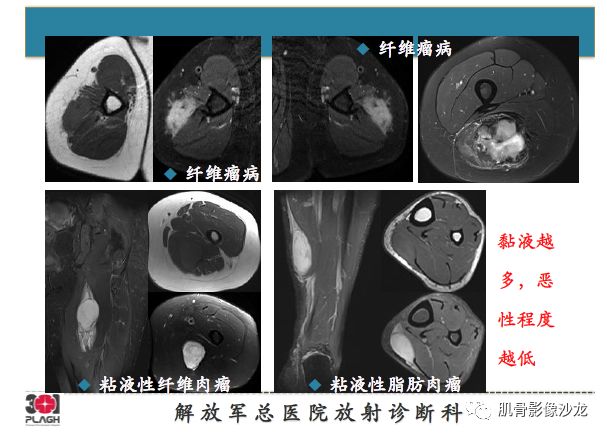 软组织肿瘤MRI诊断，这份分析思路请收下！