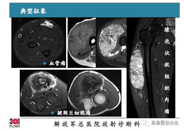 软组织肿瘤MRI诊断，这份分析思路请收下！