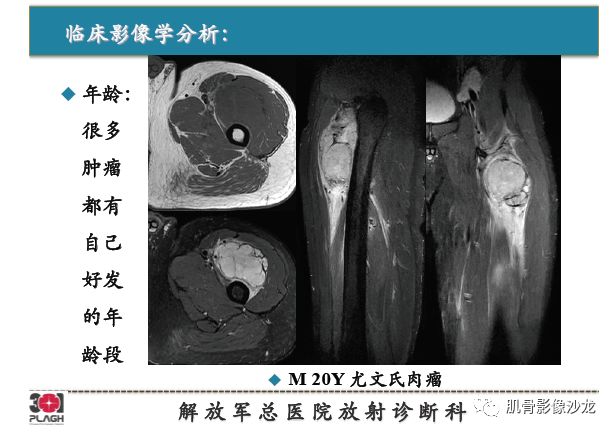 软组织肿瘤MRI诊断，这份分析思路请收下！