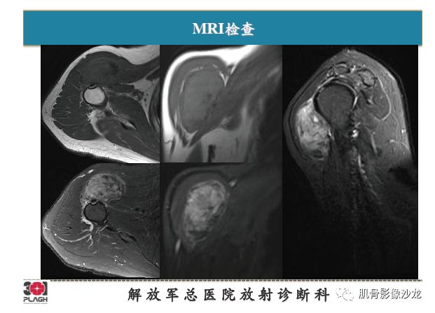 软组织肿瘤MRI诊断，这份分析思路请收下！