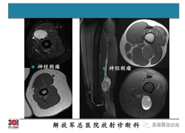 软组织肿瘤MRI诊断，这份分析思路请收下！