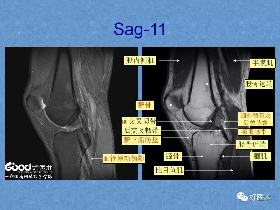 70张膝关节MRI高清解剖图解，此课件推荐收藏！