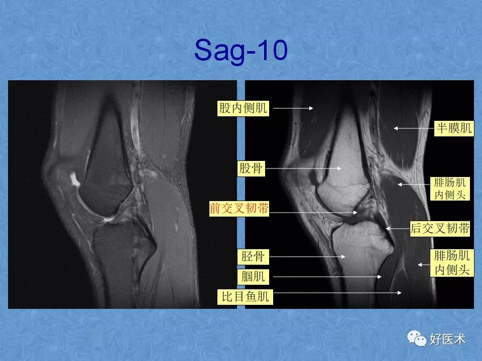 70张膝关节MRI高清解剖图解，此课件推荐收藏！