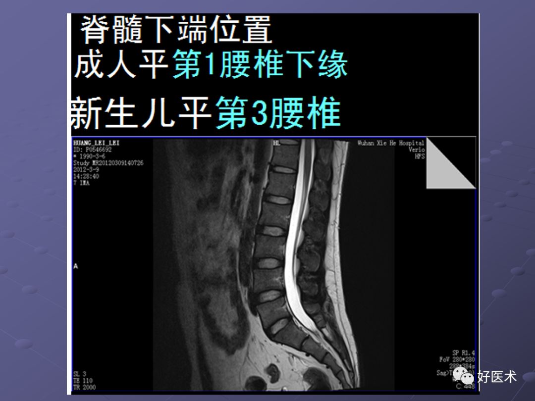 经典：脊柱常见疾病的MRI诊断技巧，都在这篇课件里！