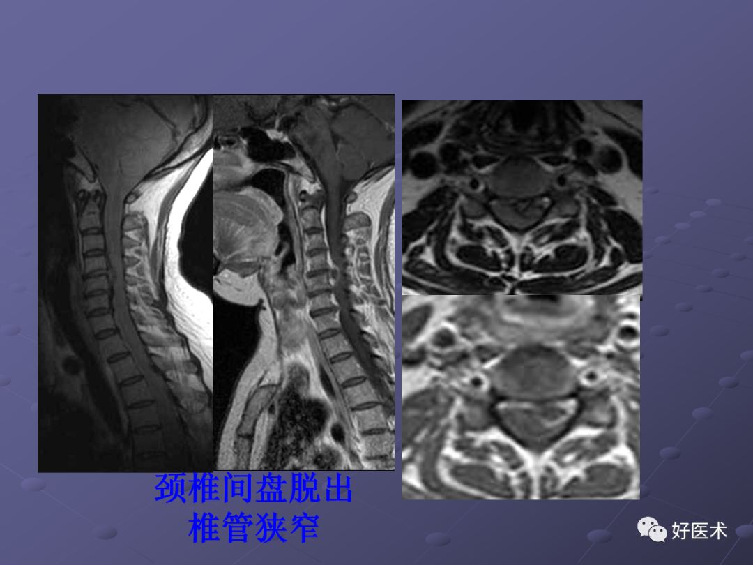 经典：脊柱常见疾病的MRI诊断技巧，都在这篇课件里！