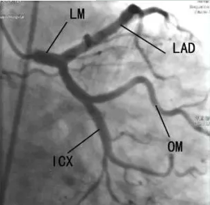 作用、体位、禁忌症……冠状动脉造影，这篇说全了！
