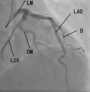 作用、体位、禁忌症……冠状动脉造影，这篇说全了！