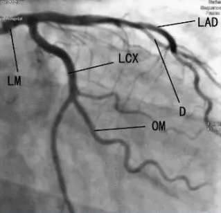 作用、体位、禁忌症……冠状动脉造影，这篇说全了！
