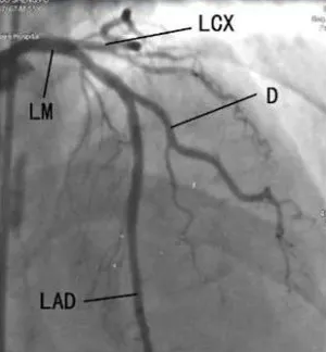 作用、体位、禁忌症……冠状动脉造影，这篇说全了！