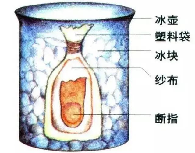 骨科常见手部外伤的诊断及治疗技巧，详细答案全解！