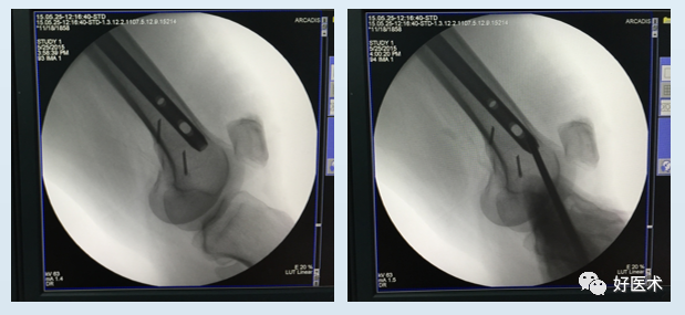 实用干货：股骨远端成功锁定，操作技巧超全解析！