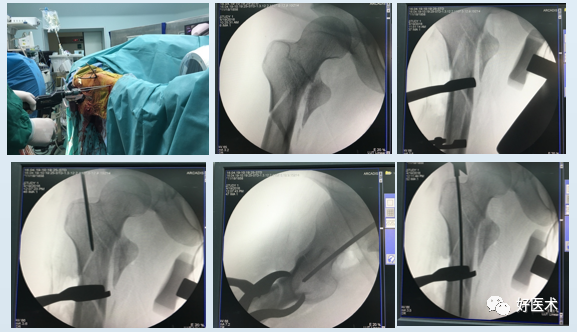 实用干货：股骨远端成功锁定，操作技巧超全解析！