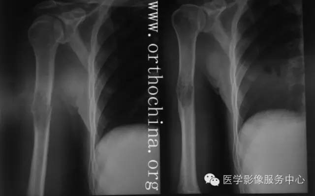 图文详解：11种骨转移肿瘤