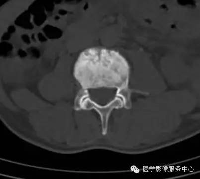 图文详解:11种骨转移肿瘤