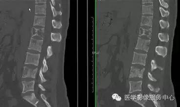 图文详解:11种骨转移肿瘤