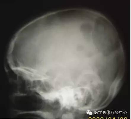 图文详解:11种骨转移肿瘤