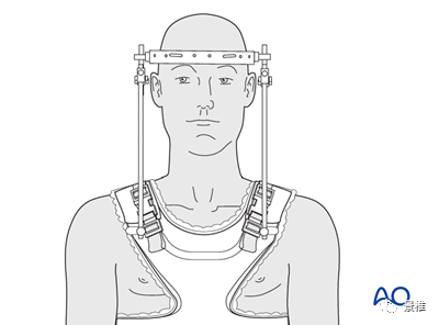 骨科必看：Hangman骨折诊疗与Halo架标准打法，纯高清图解！