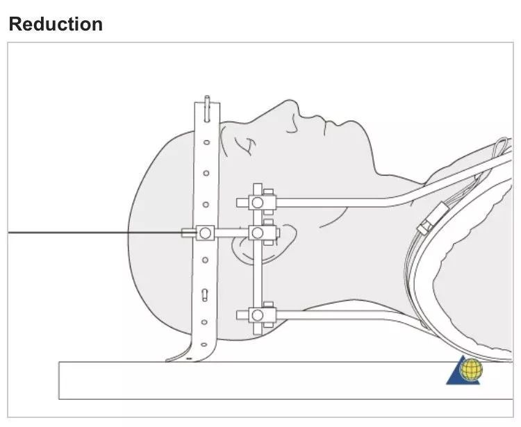 骨科必看：Hangman骨折诊疗与Halo架标准打法，纯高清图解！
