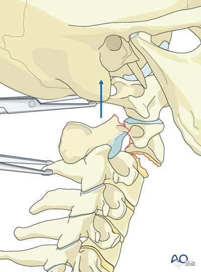 骨科必看：Hangman骨折诊疗与Halo架标准打法，纯高清图解！