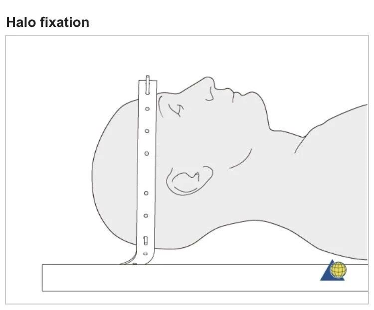 骨科必看：Hangman骨折诊疗与Halo架标准打法，纯高清图解！