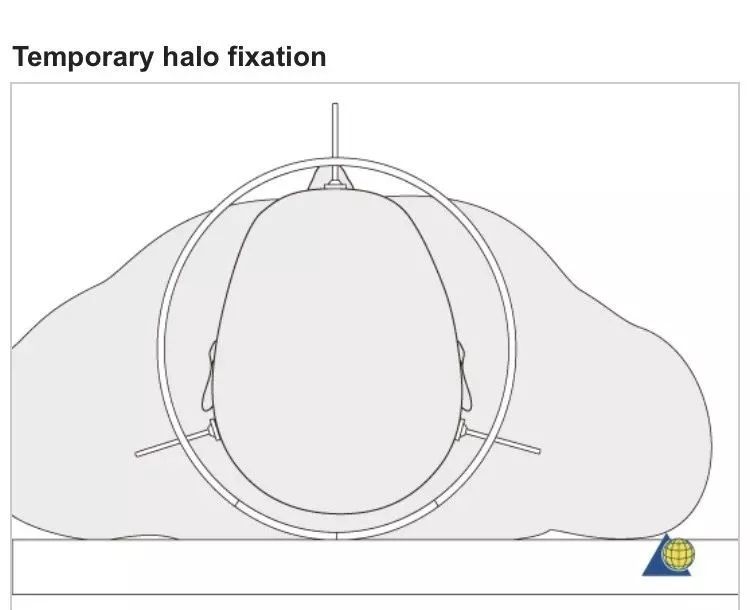 骨科必看：Hangman骨折诊疗与Halo架标准打法，纯高清图解！