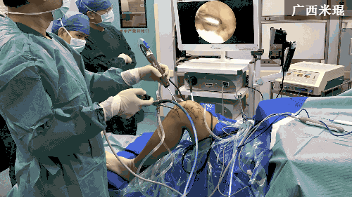 高清动图详解前交叉韧带重建手术全过程，临床必看！