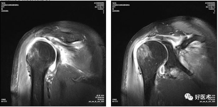 干货分享：不同的肩痛患者，这些影像学诊断技巧很实用！