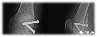 从诊断、分型、治疗到固定技巧，全面讲解Hoffa骨折！