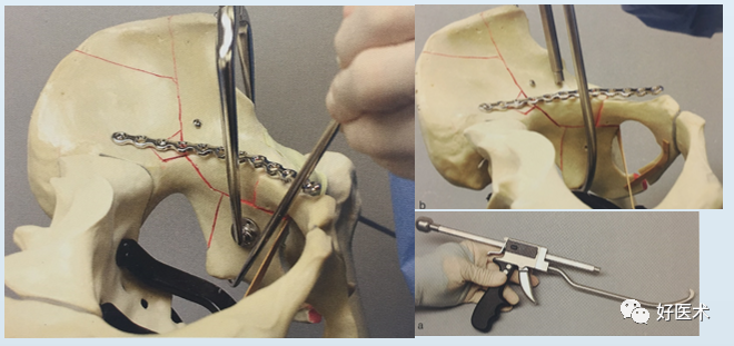 看图速学：髋臼骨折标准且极具代表的手术入路，操作细节与技巧全解！