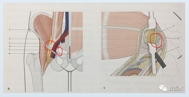 看图速学:髋臼骨折标准且极具代表的手术入路,操作细节与技巧全解!