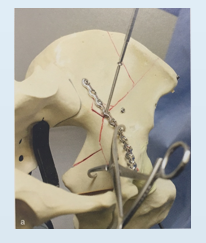 看图速学：髋臼骨折标准且极具代表的手术入路，操作细节与技巧全解！