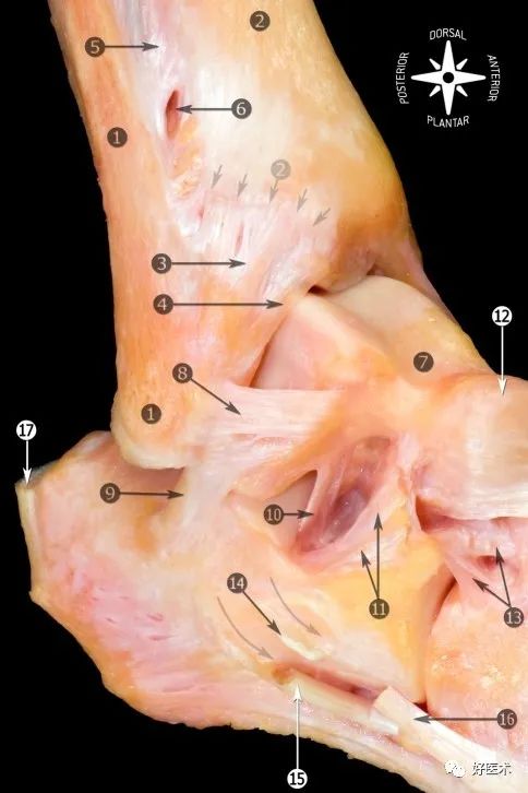 1距腓前韧带;2下胫腓前韧带;3跟腓韧带;4伸肌上支持带;5伸肌下支持带