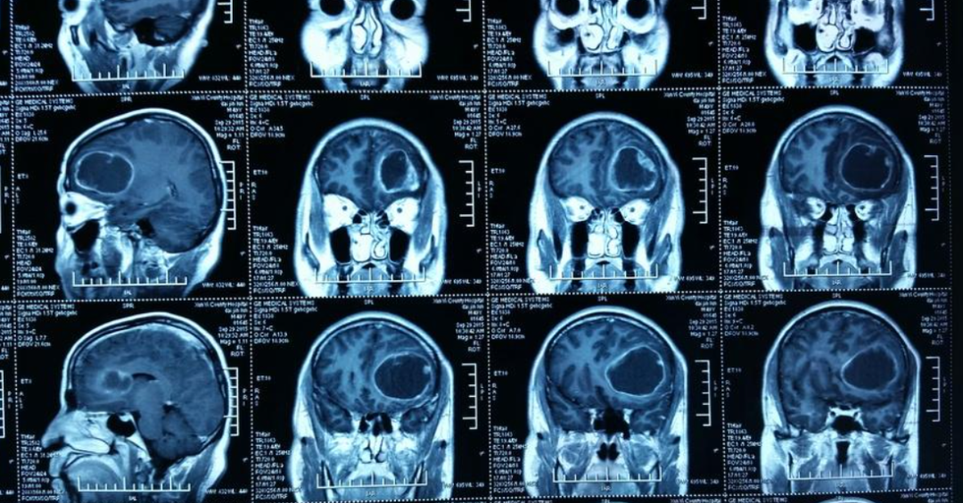 脑胶质瘤影像分析，鉴别诊断拎清楚！