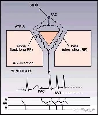阵发性室上性心动过速：从发作诊断到处理，一文详解！