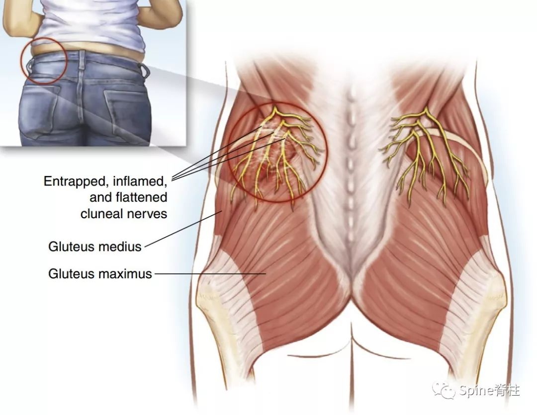 3分钟掌握：门诊容易忽略的疾病--臀上皮神经卡压综合征！