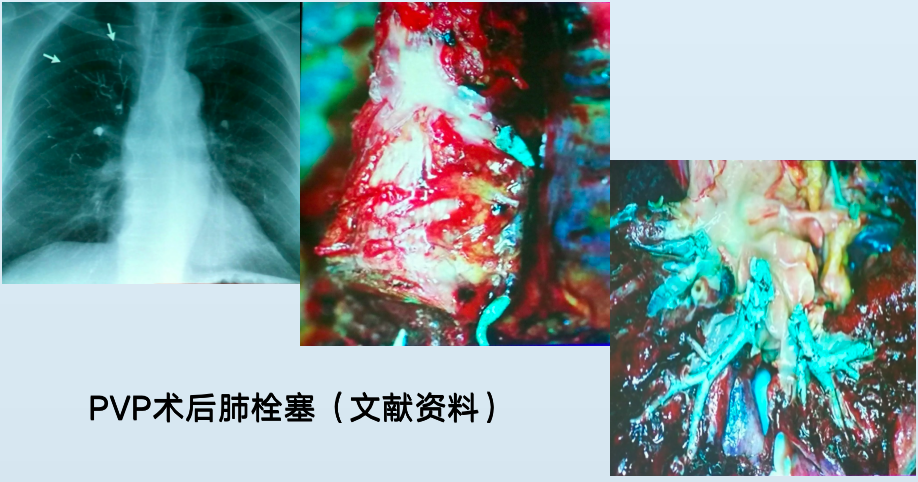 骨质疏松骨折患者，规范化治疗方案注意查收！