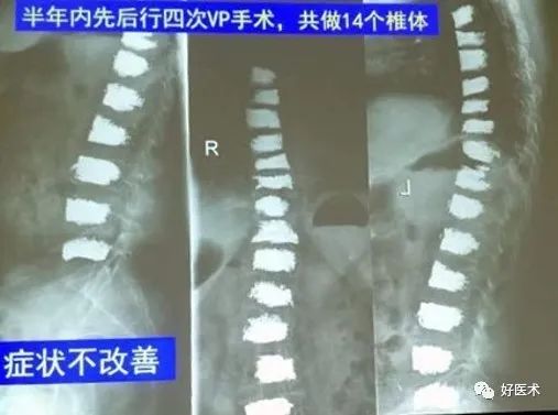 骨质疏松骨折患者，规范化治疗方案注意查收！